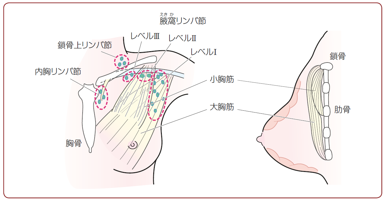 Q21 現在の標準的な手術の方法は何ですか ガイドライン 患者さんのための乳癌診療ガイドライン2019年版